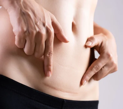 Etapy gojenia się rany po cesarskim cięciu