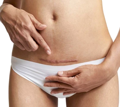 Wskazania do cesarskiego cięcia