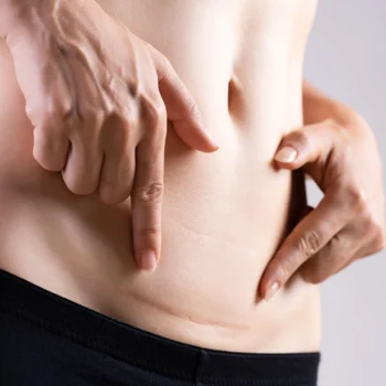 Etapy gojenia się rany po cesarskim cięciu